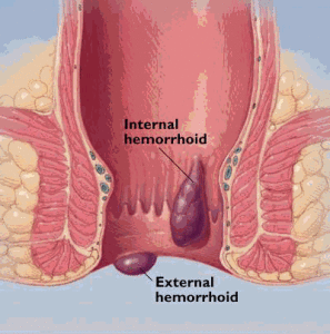 HEMOROIDI-Unutrasnji-i-spoljasnji-hemoroidi