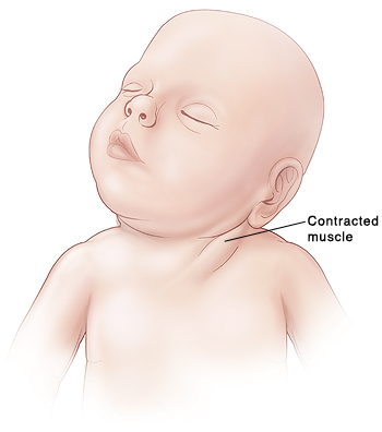 Infant with Congenital Muscular Torticollis Source:  http://www.netterimages.com/image/2034.htm http://www.bostream.nu/torticollis/torteng.htm