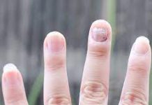 Sinoc sam namazala ovu smjesu na gljivice na noktima: one su nestale kao rukom odnesene, genijalan recept mi spasio zivot Sinoc sam namazala ovu smjesu na gljivice na noktima: one su nestale kao rukom odnesene, genijalan recept mi spasio zivot - featured image