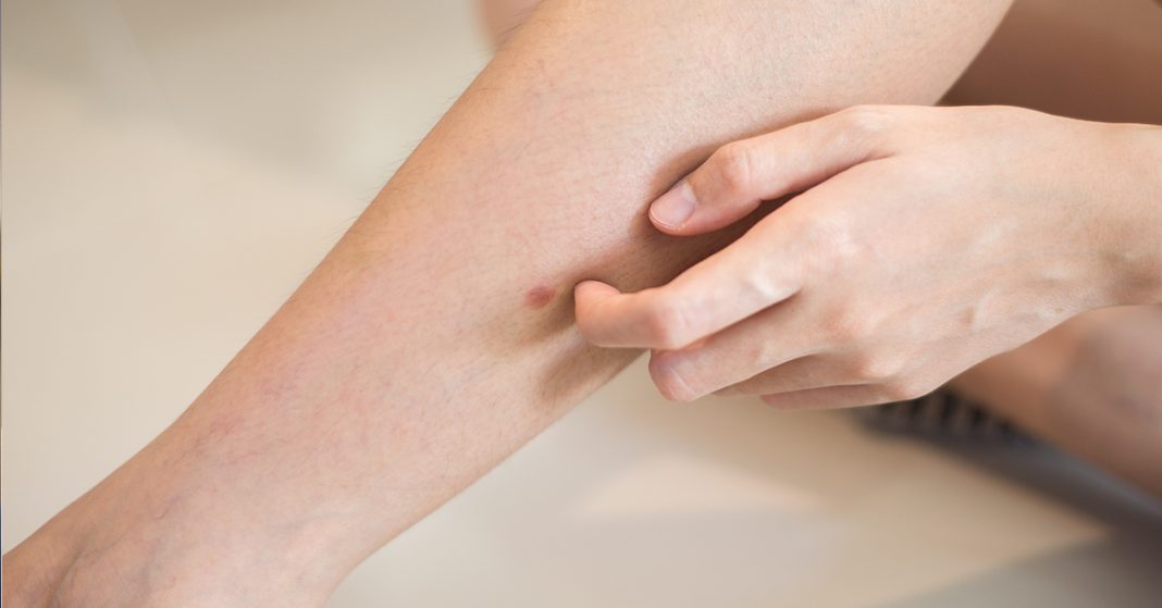 „Šta uzrokuje svrab na različitim dijelovima tijela: kada je bezopasan, a kada potražiti savjet ljekara“ - featured image