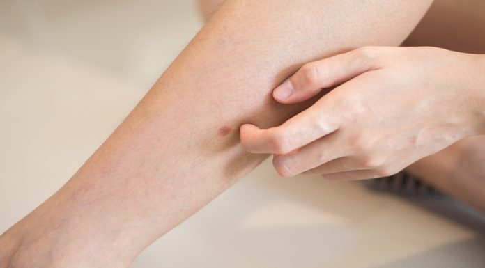 „Šta uzrokuje svrab na različitim dijelovima tijela: kada je bezopasan, a kada potražiti savjet ljekara“ „Šta uzrokuje svrab na različitim dijelovima tijela: kada je bezopasan, a kada potražiti savjet ljekara“ - featured image