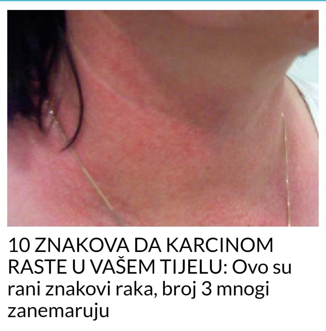 10 ZNAKOVA DA KARCINOM RASTE U VAŠEM TIJELU: Ovo su rani znakovi raka, broj 3 mnogi zanemaruju - featured image 10 ZNAKOVA DA KARCINOM RASTE U VAŠEM TIJELU: Ovo su rani znakovi raka, broj 3 mnogi zanemaruju - featured image