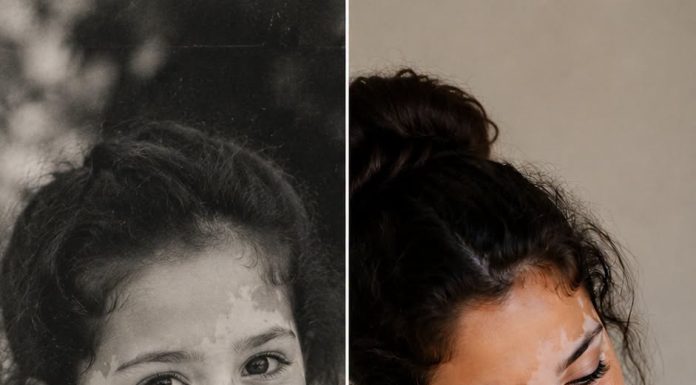 Moja svekrva rekla je da moj vitiligo „uništava obiteljsku lozu“ — a onda se rodila moja beba, i ono što je učinila izazvalo je posljednju reakciju mog supruga 💔😢 Moja svekrva rekla je da moj vitiligo „uništava obiteljsku lozu“ — a onda se rodila moja beba, i ono što je učinila izazvalo je posljednju reakciju mog supruga 💔😢 - featured image