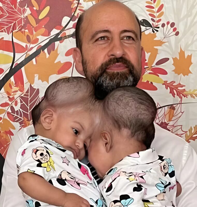 Kako su Manal i Mirhi dobile šansu za odvojene živote nakon jedne od najtežih operacija - featured image Kako su Manal i Mirhi dobile šansu za odvojene živote nakon jedne od najtežih operacija - featured image
