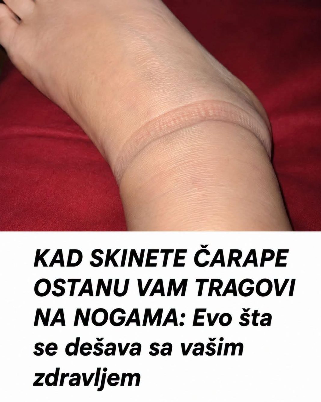 KAD SKINETE ČARAPE OSTANU VAM TRAGOVI NA NOGAMA: Evo šta se dešava sa vašim zdravljem - featured image