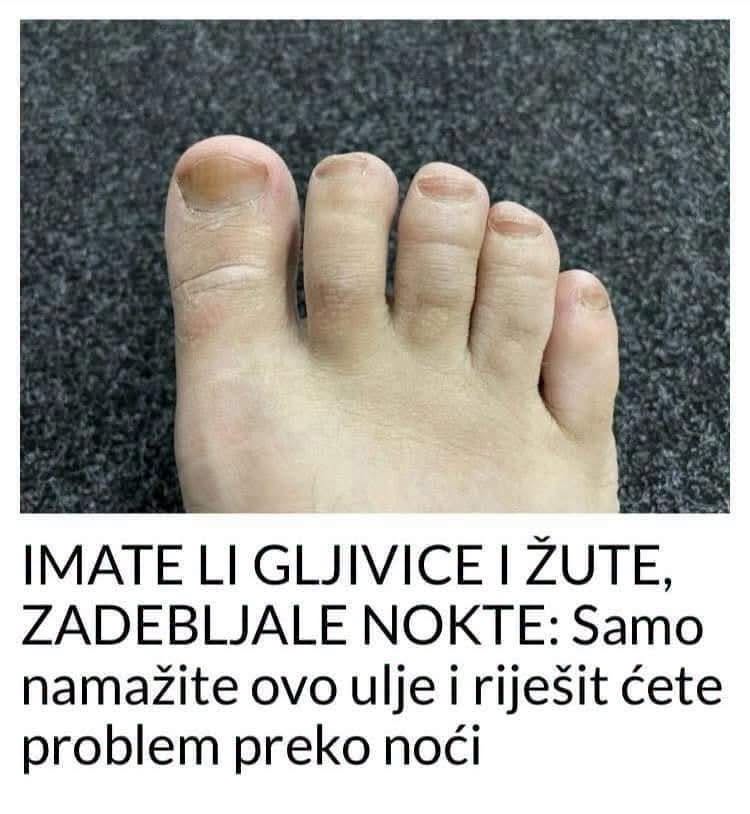 IMATE LI GLJIVICE I ŽUTE, ZADEBLJALE NOKTE: Samo namažite ovo ulje i riješit ćete problem preko noći - featured image IMATE LI GLJIVICE I ŽUTE, ZADEBLJALE NOKTE: Samo namažite ovo ulje i riješit ćete problem preko noći - featured image