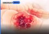 Rani simptomi raka debelog creva: 1 izgleda bezopasno, a baš njega većina ljudi svakog dana ignoriše Rani simptomi raka debelog creva: 1 izgleda bezopasno, a baš njega većina ljudi svakog dana ignoriše - featured image