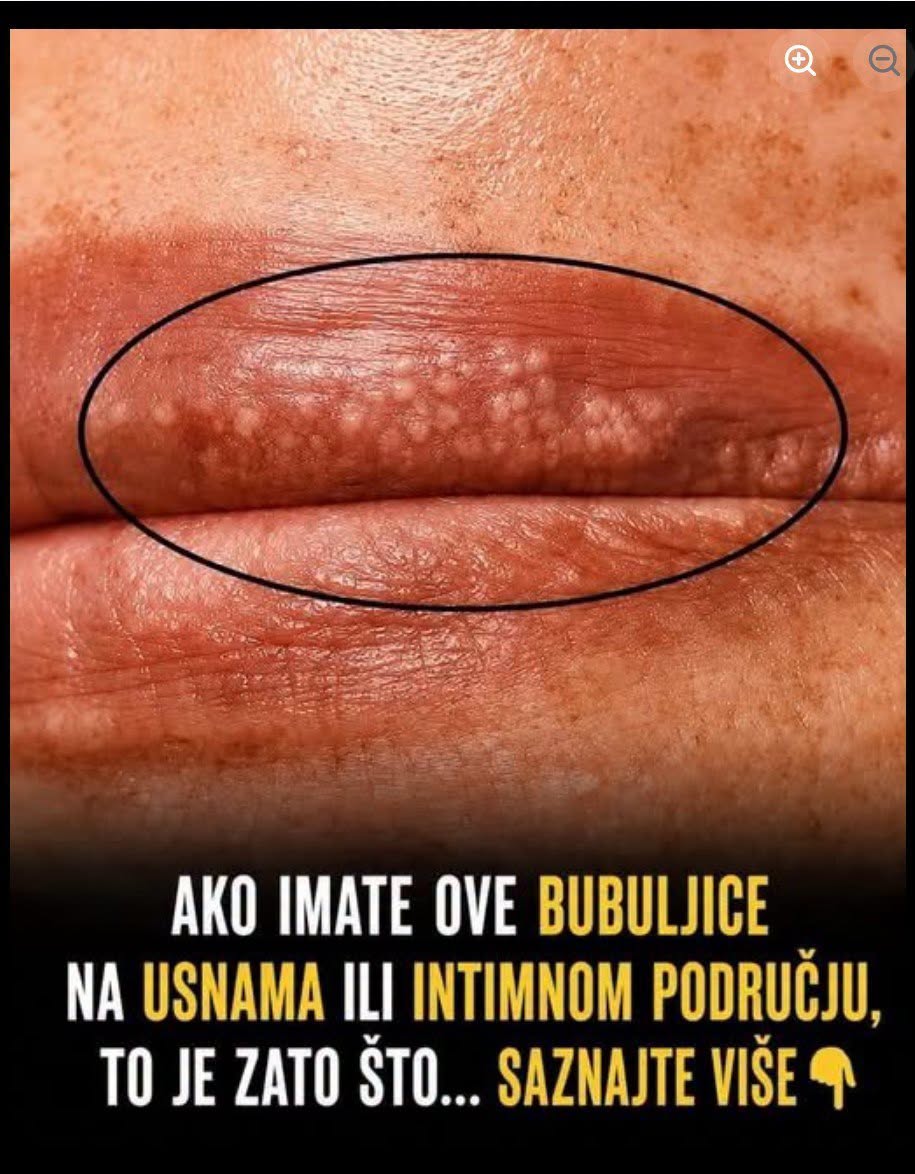 Bele fleke na usnama ili intimnom području? Ne ignorišite ove znake upozorenja! - featured image Bele fleke na usnama ili intimnom području? Ne ignorišite ove znake upozorenja! - featured image