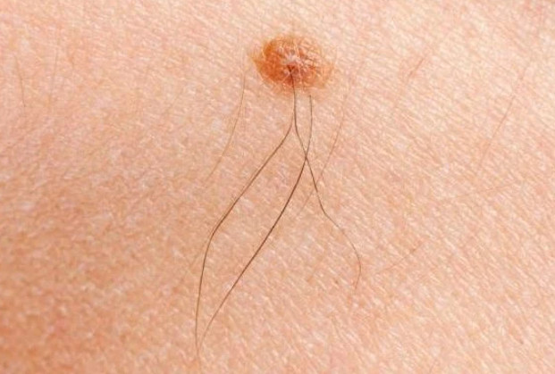 Imate mladež iz kojeg raste dlaka? Evo šta tačno znači kada vam iz mladeža raste dlaka - featured image Imate mladež iz kojeg raste dlaka? Evo šta tačno znači kada vam iz mladeža raste dlaka - featured image