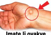 IMATE LI OVAKVE IZRASLINE: Evo kako da ih se riješite PREKO NOĆI IMATE LI OVAKVE IZRASLINE: Evo kako da ih se riješite PREKO NOĆI - featured image