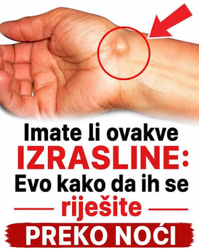 IMATE LI OVAKVE IZRASLINE: Evo kako da ih se riješite PREKO NOĆI - featured image IMATE LI OVAKVE IZRASLINE: Evo kako da ih se riješite PREKO NOĆI - featured image
