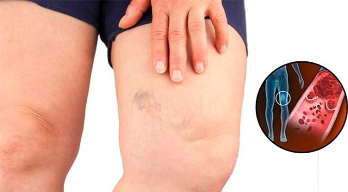 Simptomi krvnih ugrušaka u tijelu: Ako to primijetite, odmah potražite medicinsku pomoć Simptomi krvnih ugrušaka u tijelu: Ako to primijetite, odmah potražite medicinsku pomoć - featured image