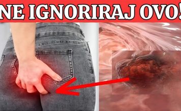 R@k debelog crijeva! UpozoravajućI znakovi I simptomi koje nikada ne smijete ignorirati. R@k debelog crijeva! UpozoravajućI znakovi I simptomi koje nikada ne smijete ignorirati. - featured image