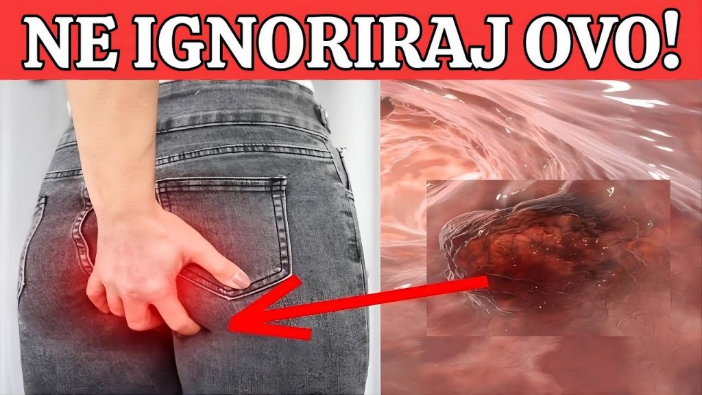 R@k debelog crijeva! UpozoravajućI znakovi I simptomi koje nikada ne smijete ignorirati. - featured image R@k debelog crijeva! UpozoravajućI znakovi I simptomi koje nikada ne smijete ignorirati. - featured image